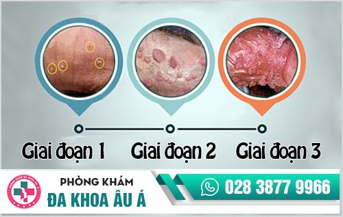 Triệu chứng bệnh sùi mào gà