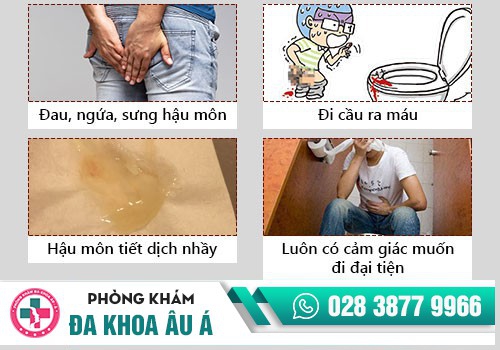 BỆNH TRĨ LÀ GÌ?