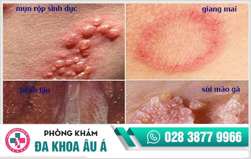 Thông tin về triệu chứng, dấu hiệu bệnh hoa liễu