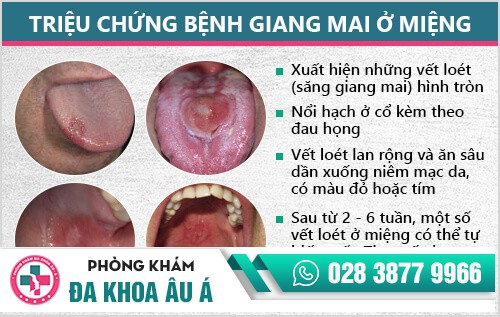 Giang mai ở miệng