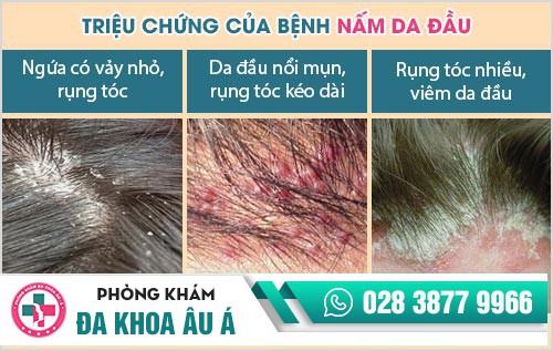Nấm da đầu cách trị tốt nhất và dứt điểm