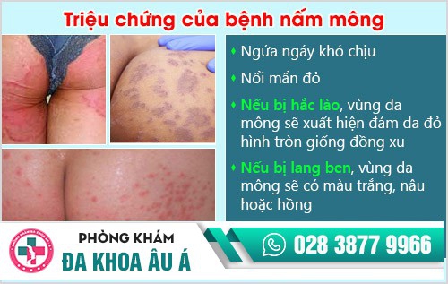 bệnh nấm mông