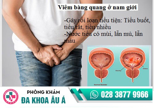 Viêm bàng quang, niệu đạo khiến đường tiết niệu tổn thương và gây đái buốt