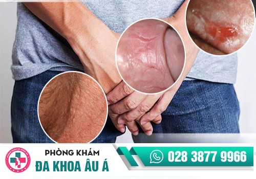 Nguyên nhân tróc da dương vật là gì?