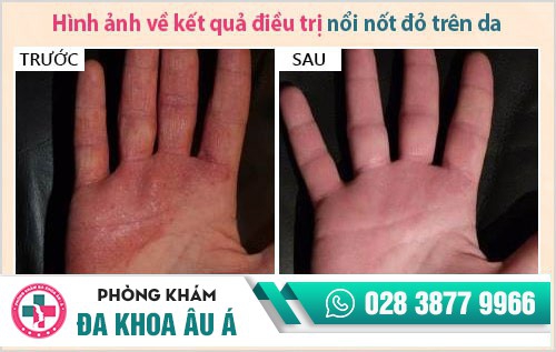nổi nốt đỏ và ngứa trên da