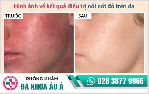 nổi nốt đỏ và ngứa trên da