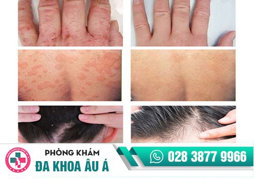 ĐIỀU TRỊ VẢY NẾN 