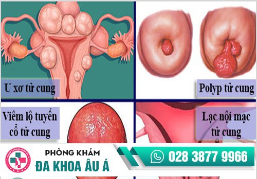 Bệnh về tử cung gây vô sinh ở nữ