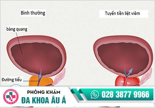 Viêm tuyến tiền liệt và nguyên nhân xuất hiện bệnh