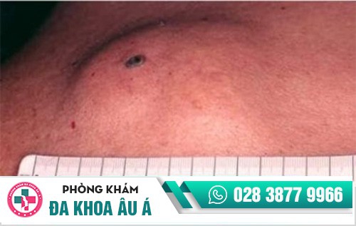 Tổng quan về u nang bã nhờn, nguyên nhân và cách điều trị