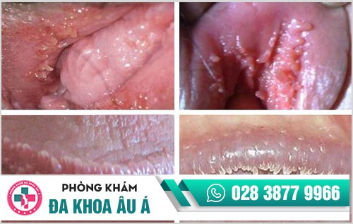 Giật mình trước tình trạng u nhú sinh dục
