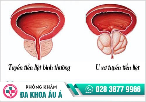 Biểu hiện u xơ tuyến tiền liệt
