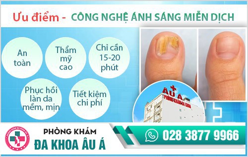 Điều trị nấm da bằng công nghệ ánh sáng miễn dịch
