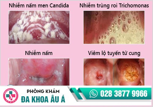Cô bé bị ngứa rát là triệu chứng bệnh gì?