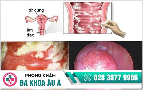 Âm đạo chảy mủ - cảnh giác với nguy cơ mắc bệnh lậu