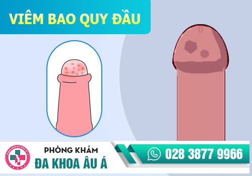 Viêm bao quy đầu 