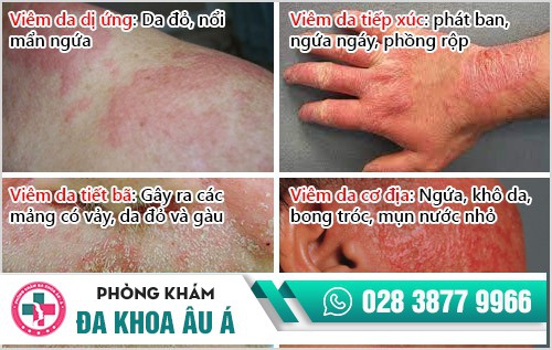phương pháp điều trị viêm da