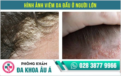 viêm da đầu