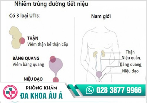 NGUYÊN NHÂN GÂY VIÊM ĐƯỜNG TIẾT NIỆU