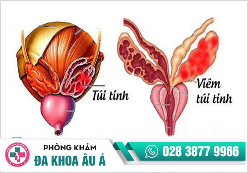 tinh trùng có mùi hôi tanh do viêm túi tinh