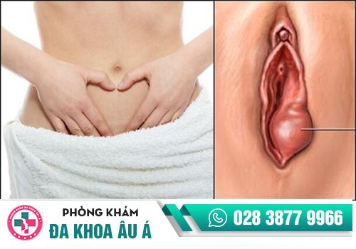 Nguyên nhân gây sưng âm đạo do đâu?