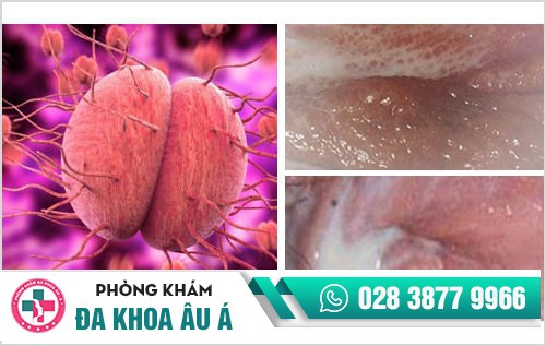 vùng kín chảy mủ