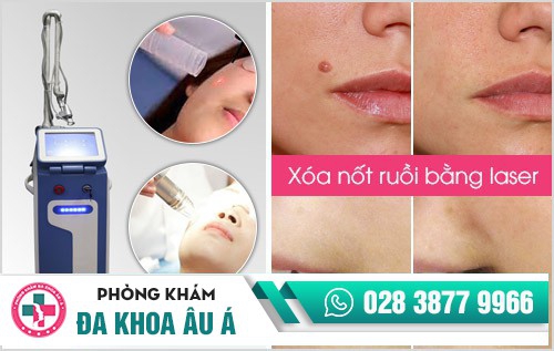 xóa nốt ruồi bằng laser