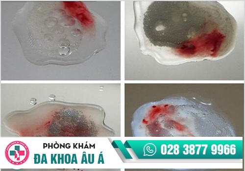 Biểu hiện của chứng xuất tinh ra máu