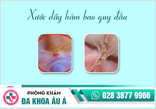 Xước dây hãm bao quy đầu
