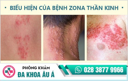 Da nổi mẩn đỏ ngứa