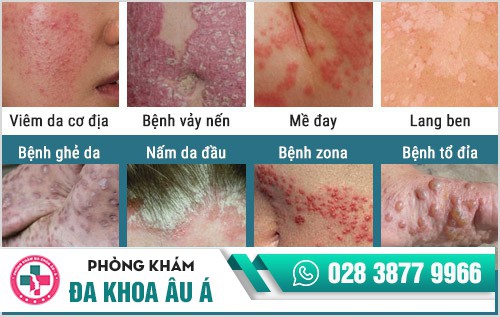 bệnh viện da liễu hcm