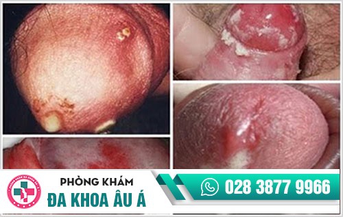 Tiểu ra dịch – Coi chừng mắc bệnh lậu