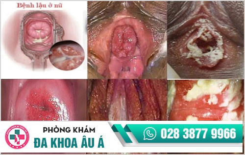 Tiểu ra dịch màu trắng ở