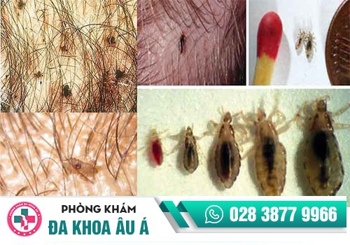 Vùng kín bị ngứa và nổi hạt là bị gì?