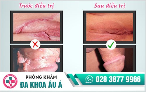 Sùi mào gà
