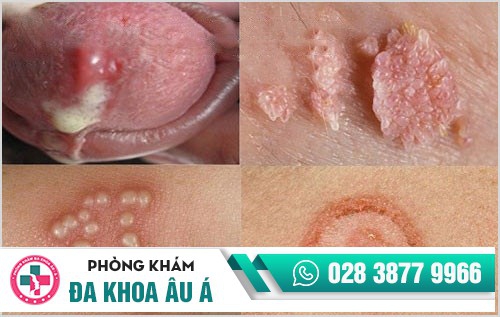 Chữa bệnh hoa liễu: Tìm đúng địa chỉ, áp dụng đúng phương pháp