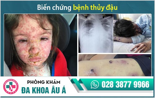 bệnh thủy đậu