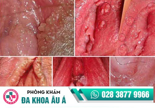 Sưng vùng kín do mắc bệnh xã hội