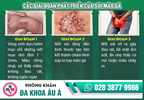 khám bệnh sùi mào gà