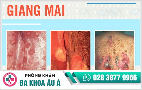 Bệnh giang mai nguy hiểm như thế nào, điều trị ra sao?