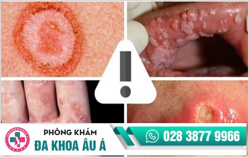 Dấu hiệu bệnh giang mai 