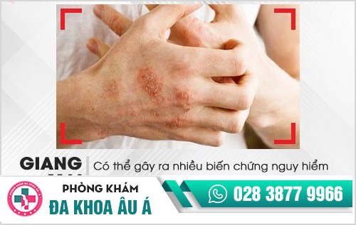 Dấu hiệu bệnh giang mai 