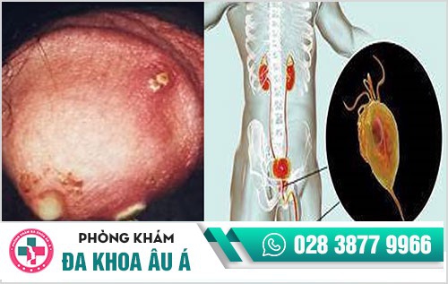 dương vật chảy mủ trắng đục