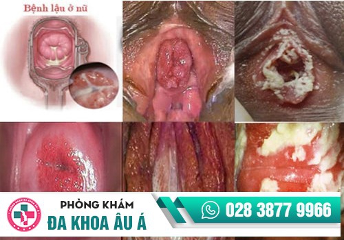 Lậu cầu gây ra tình trạng quan hệ ra máu ở nữ giới