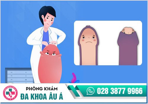 Nam giới có bao quy đầu dài, hẹp nên thực hiện cắt bao quy đầu