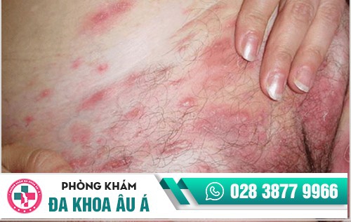 vùng kín mọc mụn