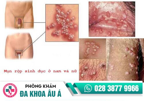 Ngứa âm đạo do mụn rộp sinh dục