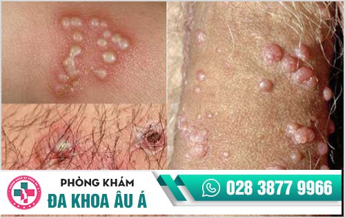 mụn rộp sinh dục nam 