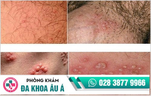 mụn sinh dục