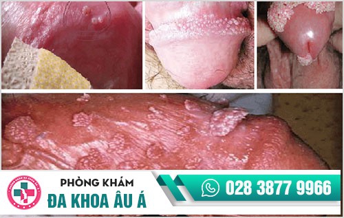 mụn sinh dục